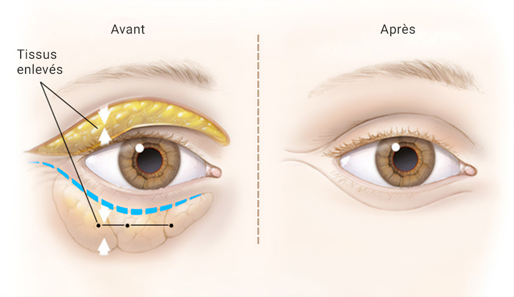 Les résultats de la blépharoplastie