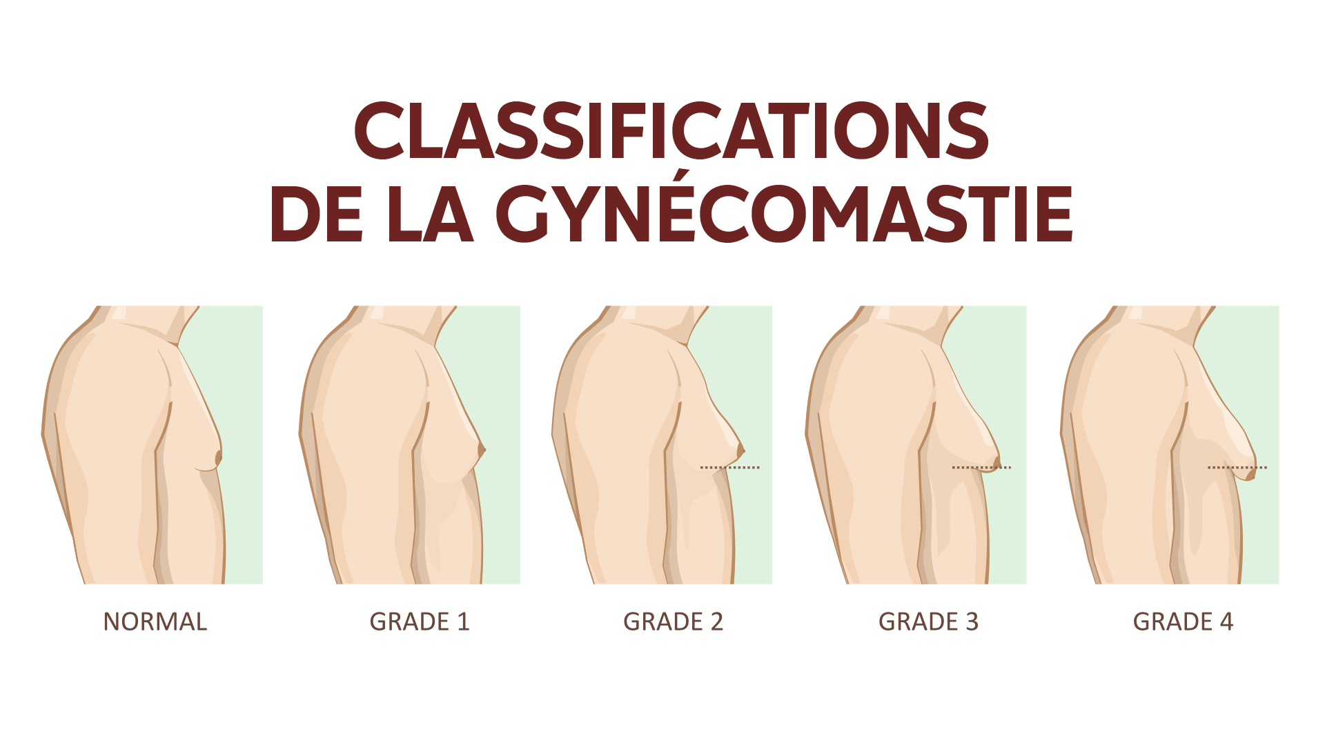 La gynécomastie, c’est quoi ?