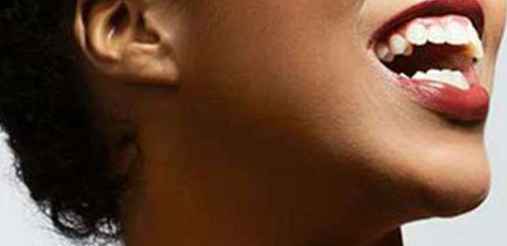 otoplastie