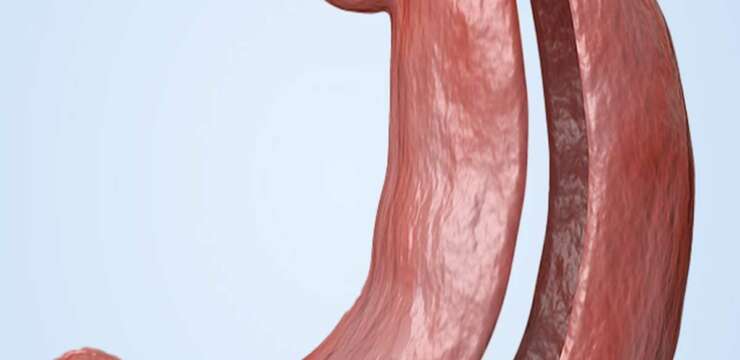 Sleeve Gastrique Tunisie