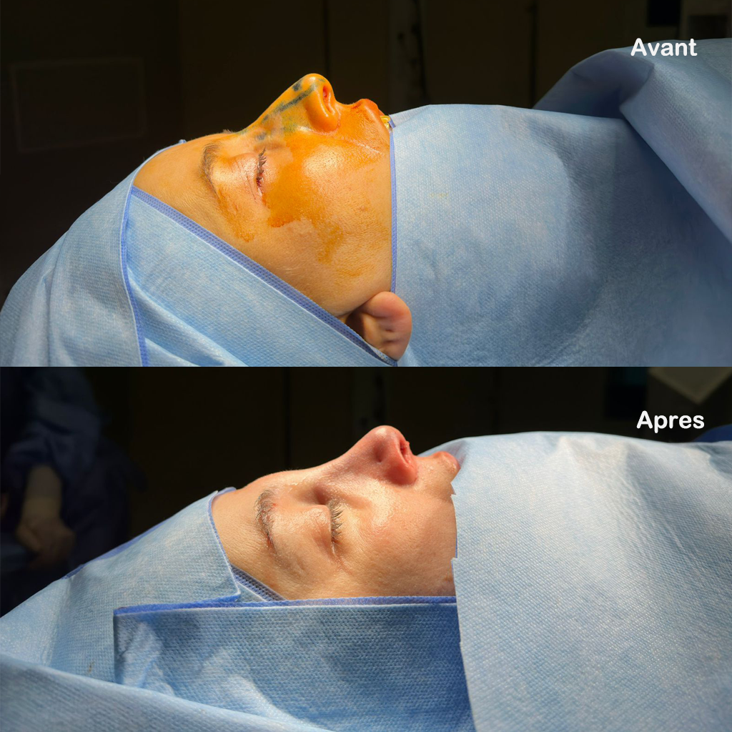 rhinoplastie-avant-apres photo avant après Rhinoplastie Tunisie