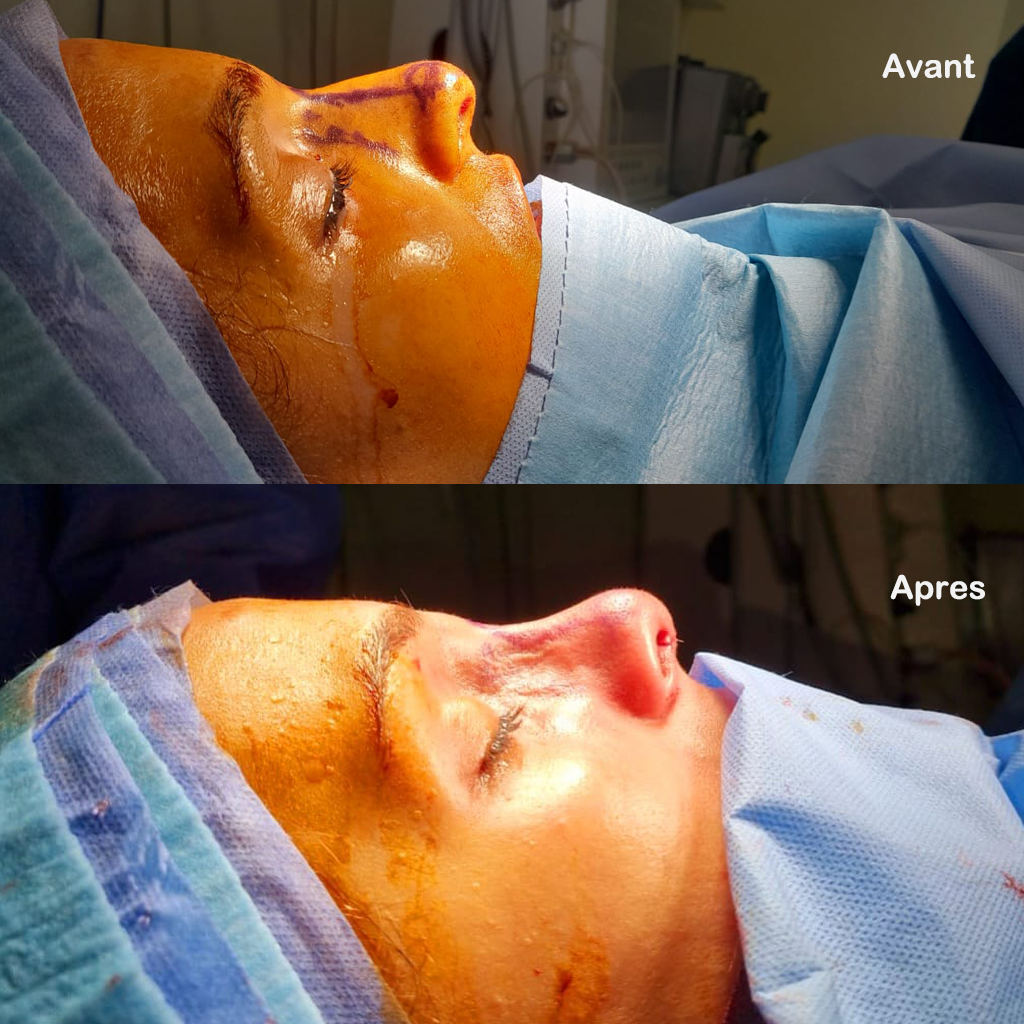 rhinoplastie-avant-apres1 photo avant après Rhinoplastie Tunisie