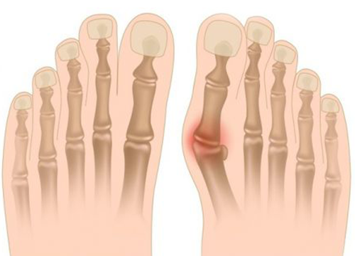 Chirurgie hallux valgus du gros orteil