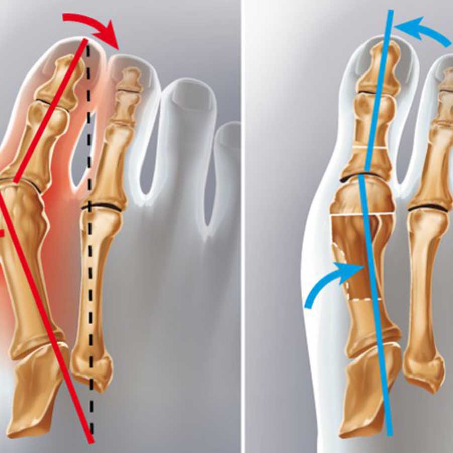 chirurgie hallux valgus tunisie