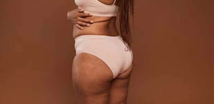 liposuccion