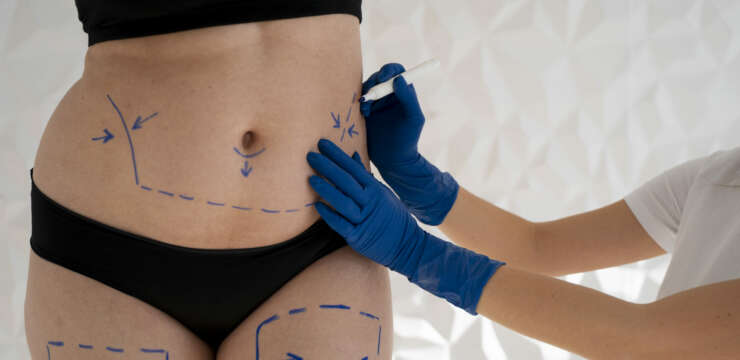 la graisse revient après une liposuccion