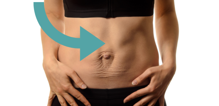 Diastasis des grands droits