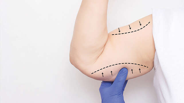 Liposuccion des bras