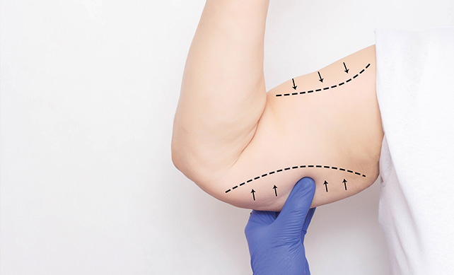 Liposuccion des bras