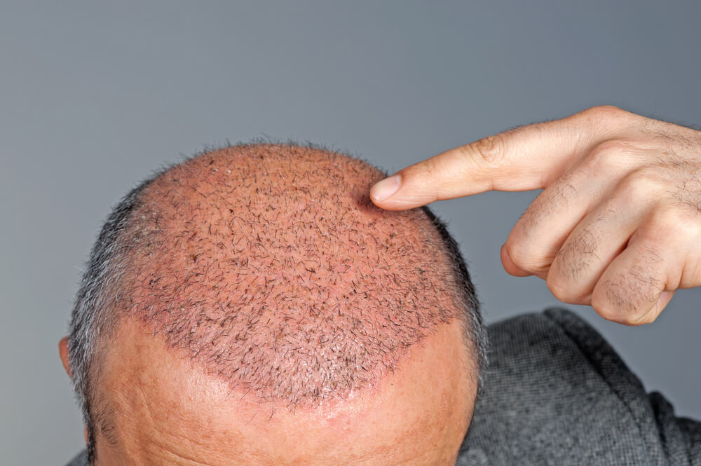 greffe de cheveux après 6 mois