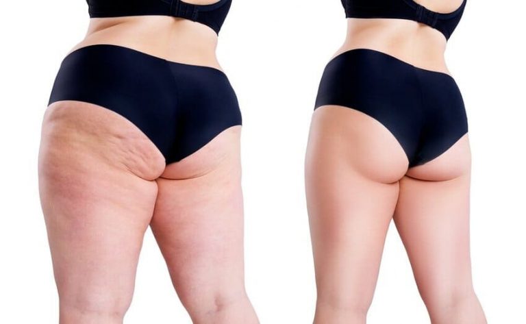 Liposuccion des cuisses Tunisie