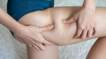 Liposuccion des cuisses Tunisie